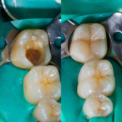 Cas traité, restauration d'une dent cariée