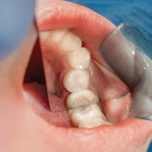 Gardez vos dents vivantes